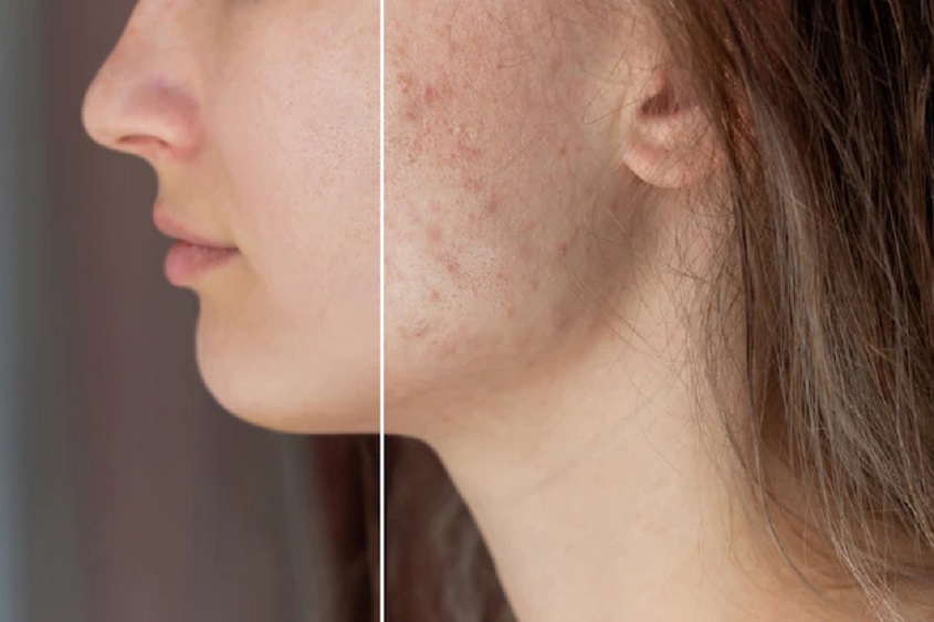 Acne Scars Treatment Doctors in Jaipur