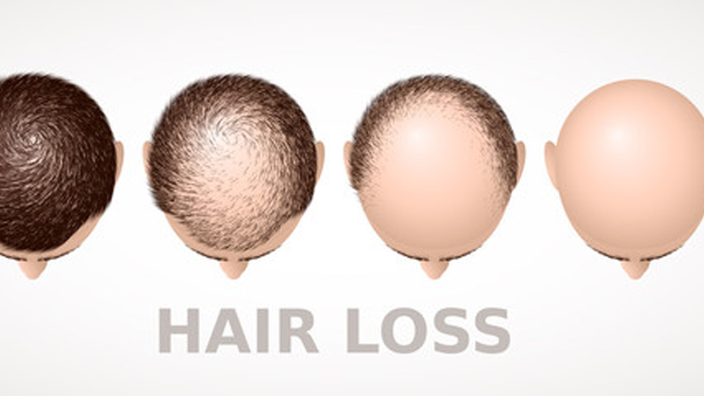 Best PRP Hair Loss Treatment in Jaipur