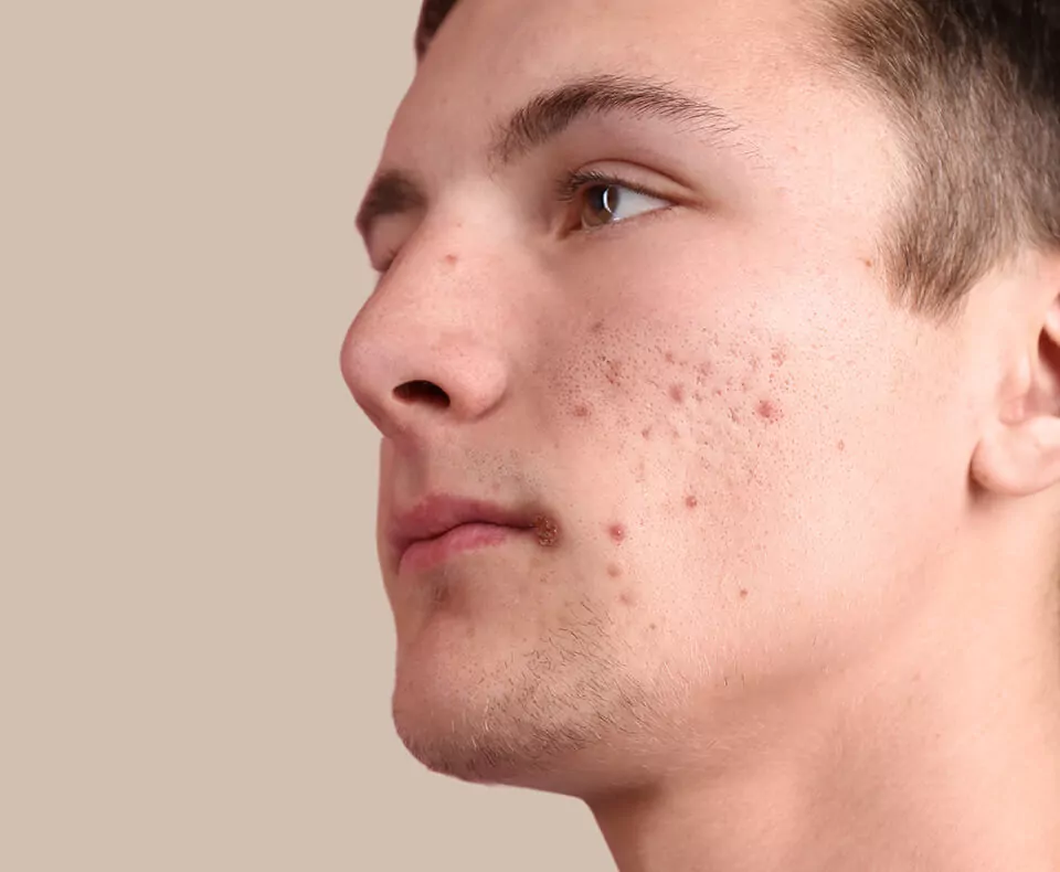 Acne Scars Treatment Doctors in Jaipur