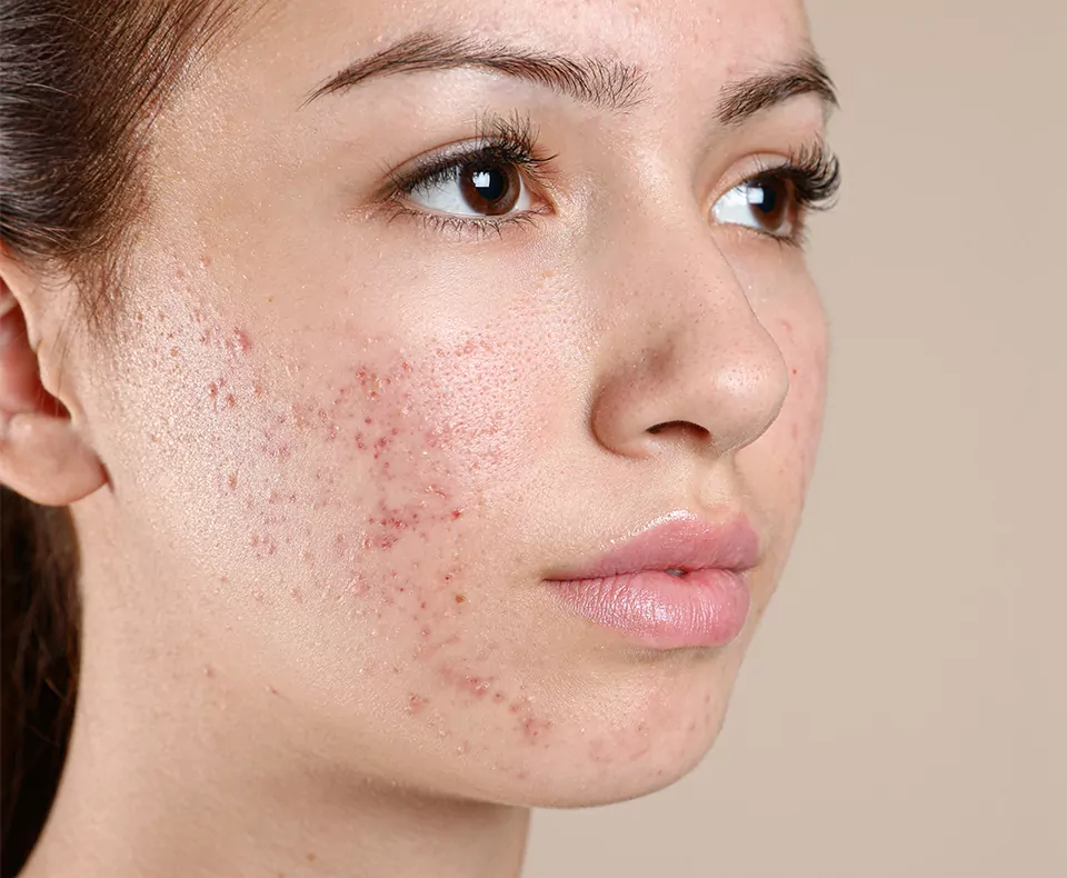 Acne Scars Treatment Doctors in Jaipur