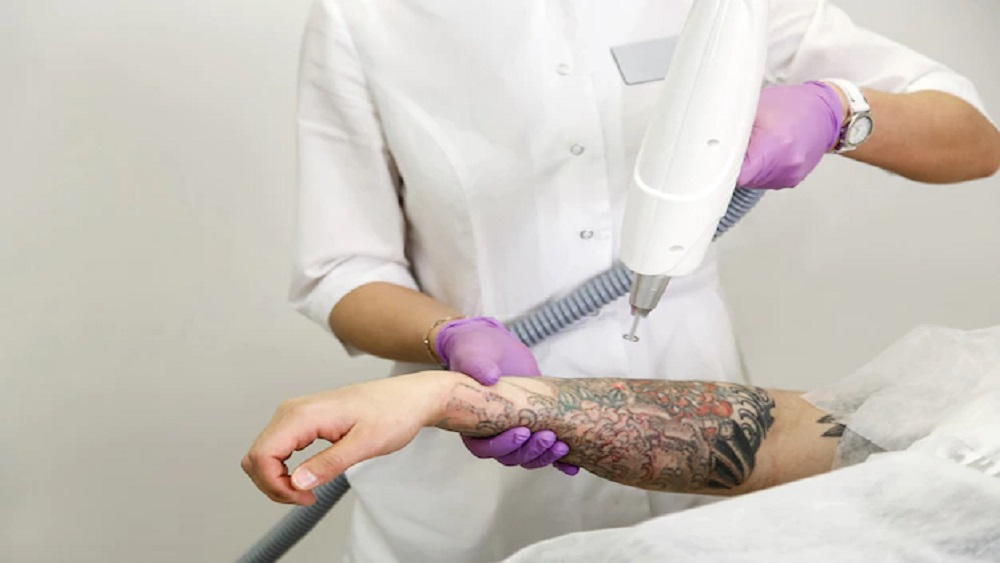 Laser Tattoo Removal in Jaipur